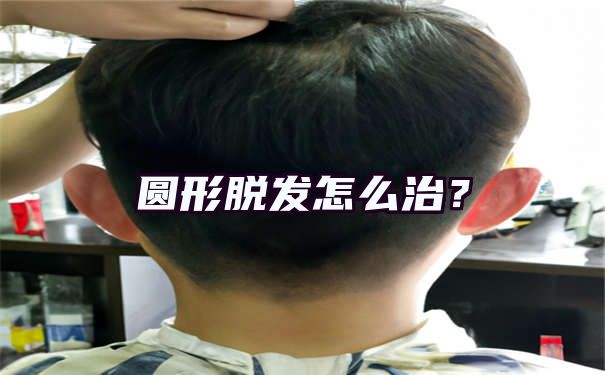 圆形脱发怎么治？